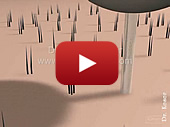 View 3d fue hair transplant animation video