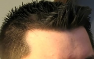 Hair Transplant Before and After Photos image3